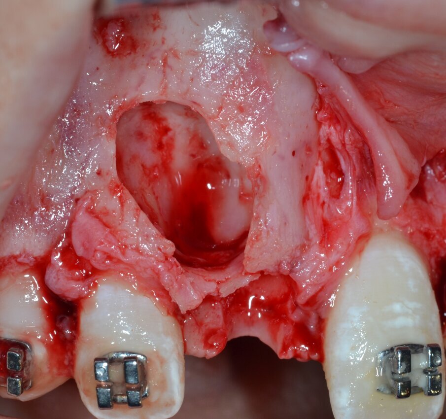 Fig. 10_Revisione chirurgica della cripta ossea residua.