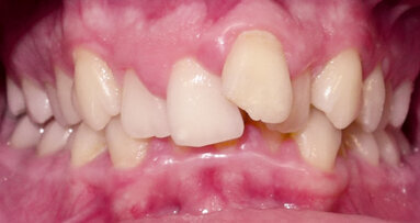 Neextrakční léčba závažného stěsnání pomocí cyklických sil a kortikotomií