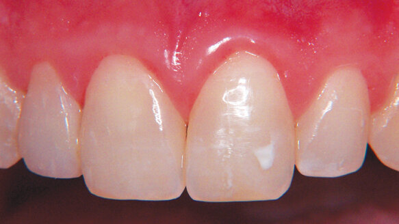 Biomimetic principles applied to cosmetic dentistry