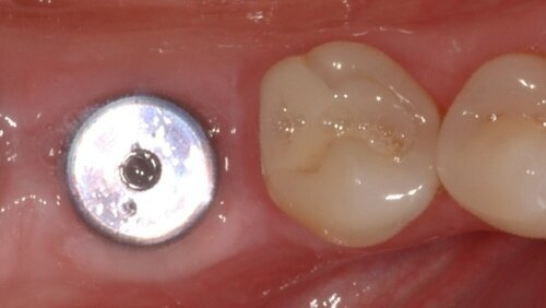 Αποζημίωση μαμούθ για λάθος εμφύτευμα