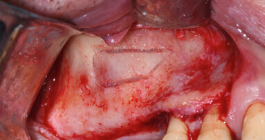 Il “Sinus Pack” per il rialzo di seno mascellare: una nuova tecnica