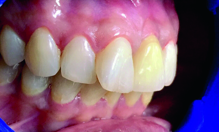 Fig. 5 : Restauration de la dent 21 avec une couronne en zircone. 