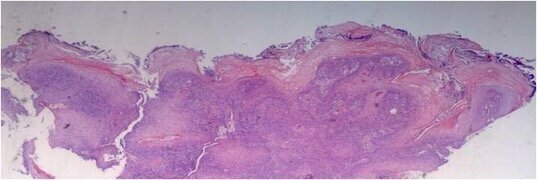 Fig. 3b - Immagine istologia di Carcinoma orale in paziente donna di 86 anni.