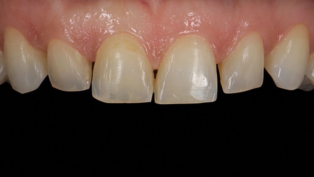 Fig. 2a. Dientes anteriores después del tratamiento de ortodoncia.