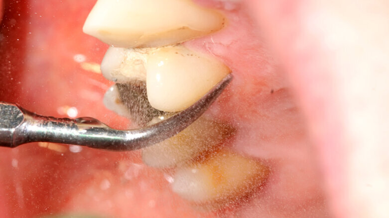 Non-surgical periodontal treatment achieves better control of Type 2 diabetes