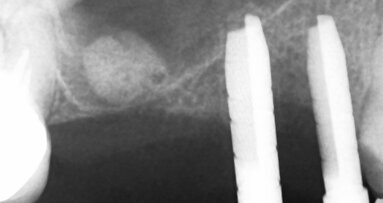 Minimálně invazivní krátké a úzké implantáty