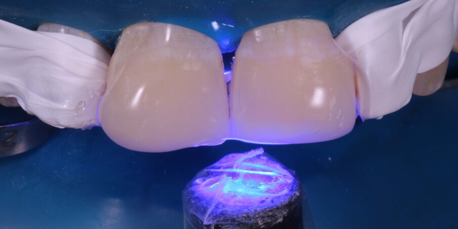 Fig 14: Photocuring with glycerin gel barrier