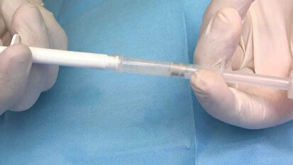 Prise en charge non chirurgicale de la péri-implantite par un traitement mécanique, antiseptique e