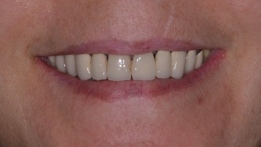 Fig. 1 - Sorriso iniziale.