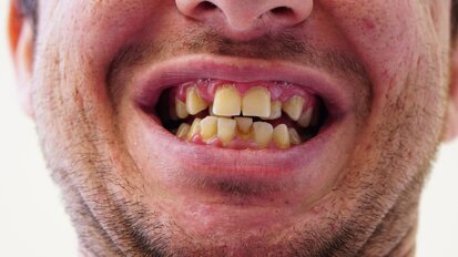 Bakterie bytujące w jamie ustnej mogą powodować wzrost komórek raka trzustki