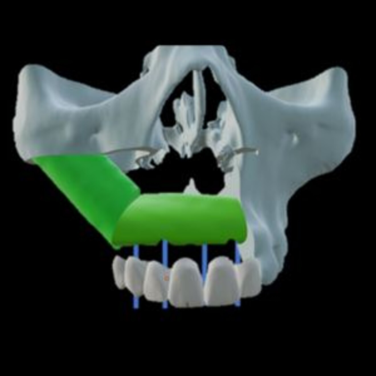 Fig. 4: Reconstructed maxilla after maxillectomy.