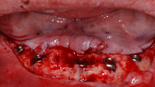 Tiologic Implants – Zirconia monolitica ceraMotion Zr ricostruzione fissa totale su impianti