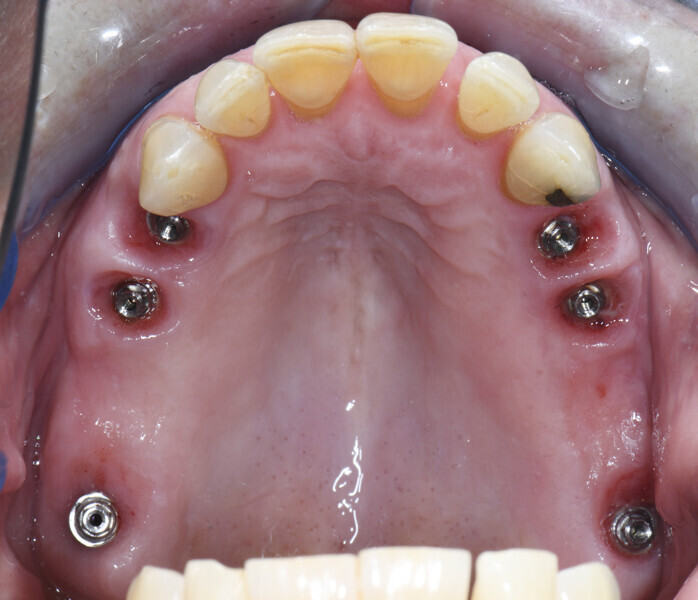 Fig. 6: Soft-tissue healing after six months.