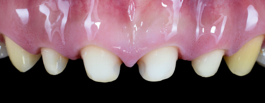 Fig. 5: Final preparation of the teeth