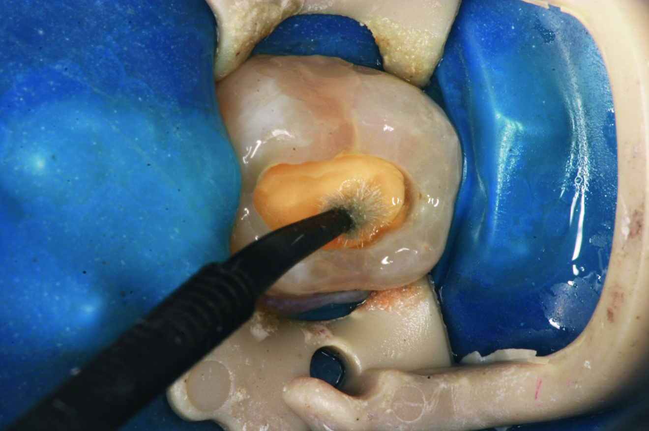 Fig. 6 : Mise en place de l’adhésif.