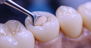 Nach dem Aus für Amalgam: Alternativen ohne zusätzliche Kosten