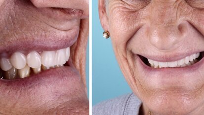 ¿Sabes cómo copiar y pegar una prótesis completa? (2)