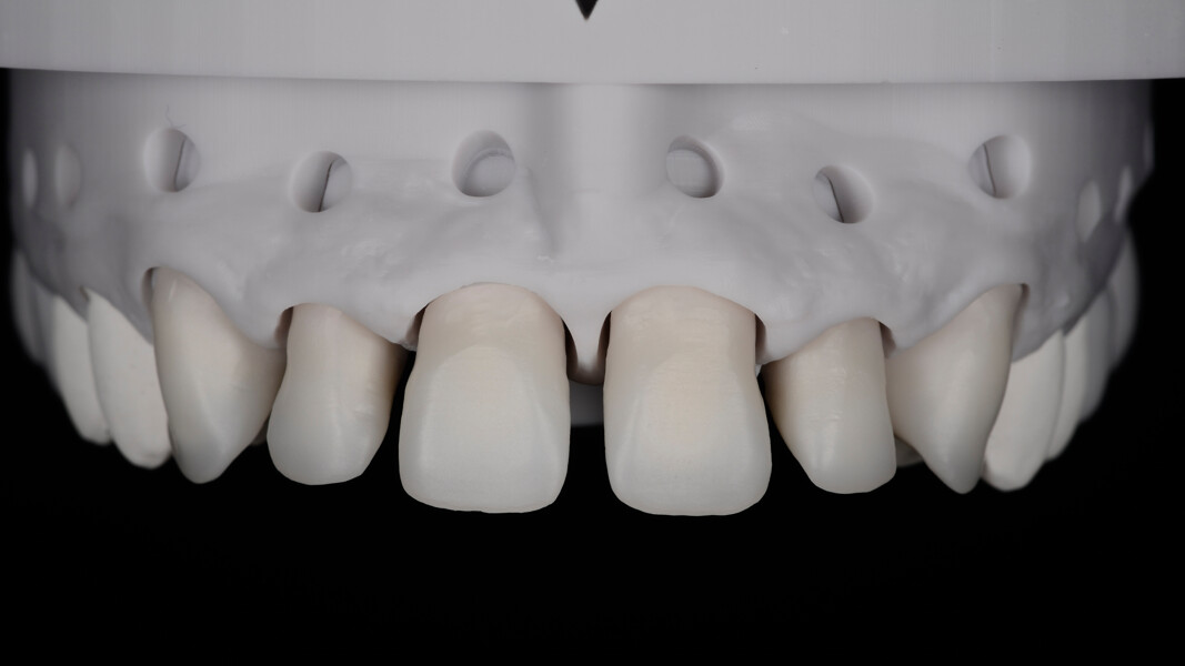 Fig. 13: Zirconia frameworks positioned on the model.