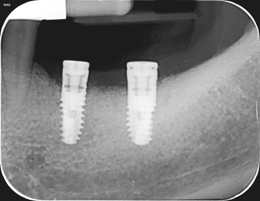 Fig. 11 - Controllo radiografico a 3 mesi, i livelli perimplantari sono mantenuti.