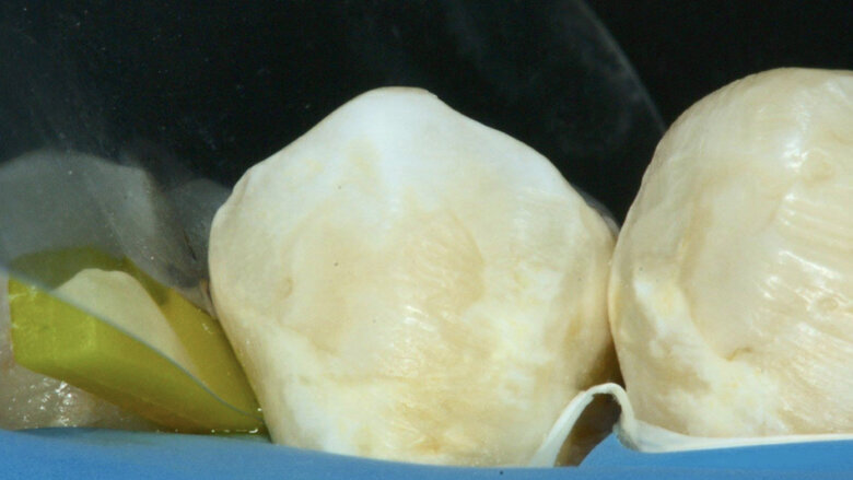 Figuras 25 y 26. Se coloca una cuña y matriz.