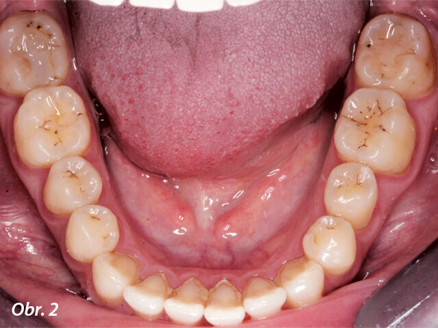 Pohled na okluzi dolního oblouku.