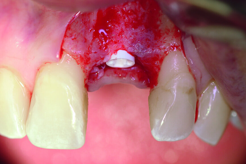 Fig. 5a: A two-piece ceramic implant was inserted.