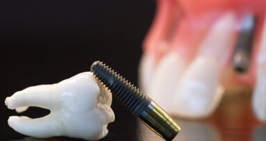 Proste i zaawansowane sposoby leczenia periimplantitis