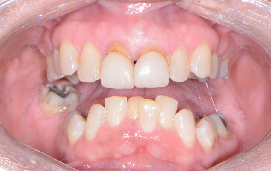 Fig. 1: Pre-op retracted frontal view