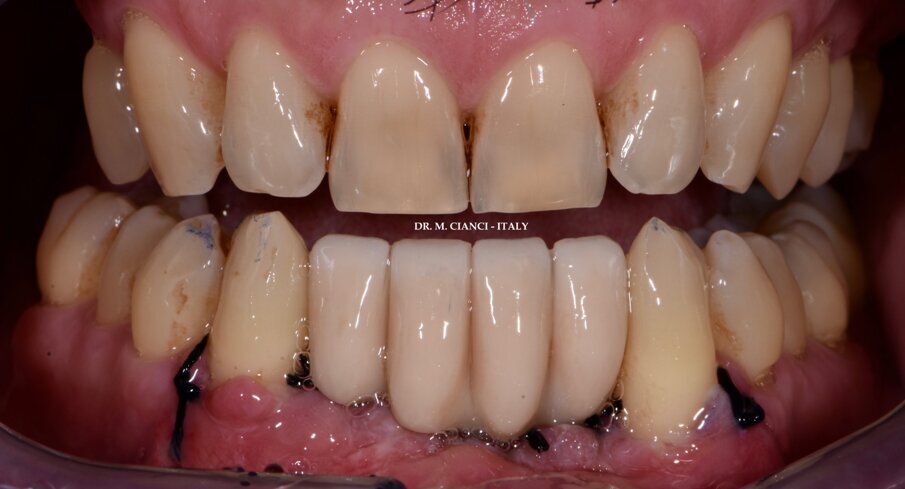 Fig. 13 - Ponte provvisorio avvitato per il carico immediato.