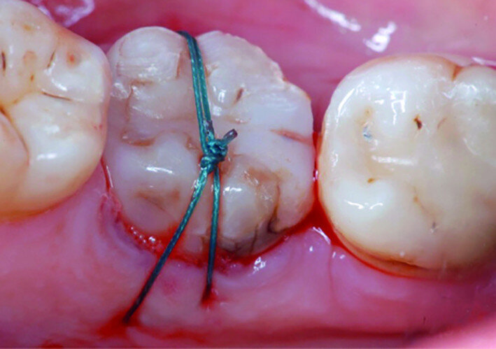 Fig. 14b: Clinical image: Tooth #38 positioned in extraction site #47.