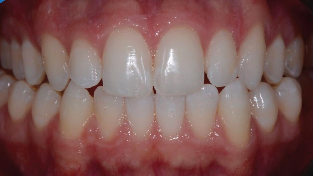 Fig. 11 - Miglioramento cromatico da 15 a 5 con remineralizzazione delle lesioni senza ulteriori trattamenti. 