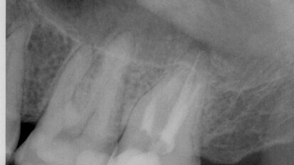 Évaluation complète d’un traitement de canal radiculaire supérieur