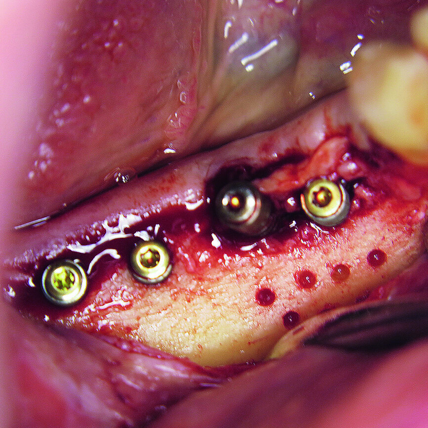 Fig. 2: Micro-osteoperforation in order to enhance bone formation.