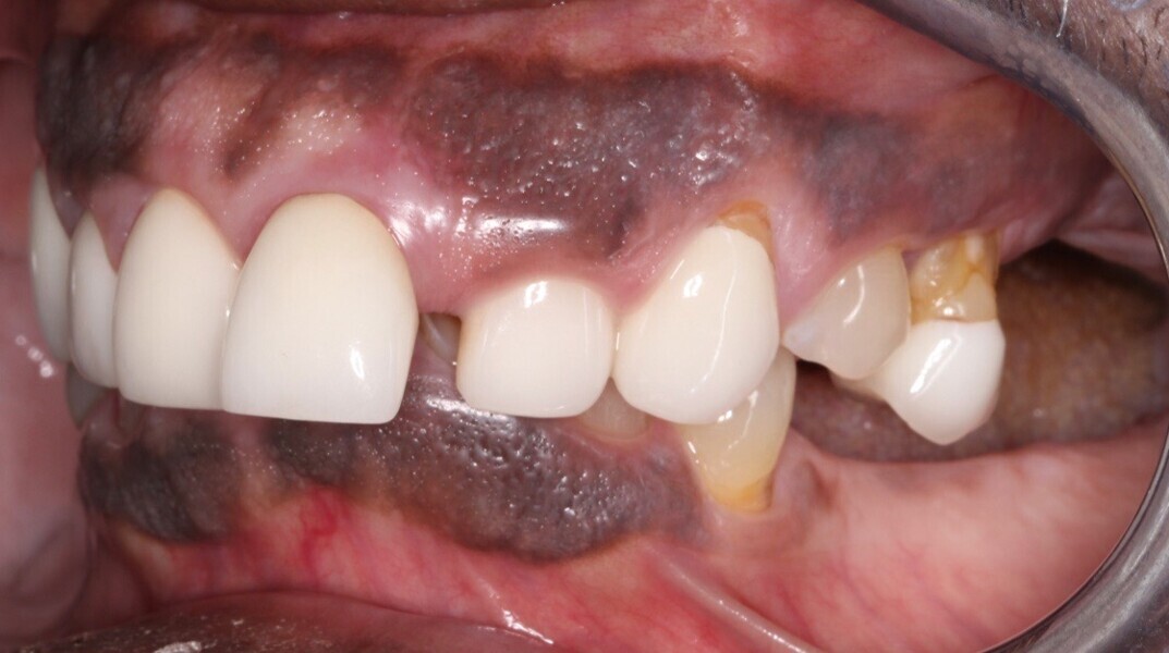 Fig. 10: Left lateral view of the teeth in maximum intercuspation.