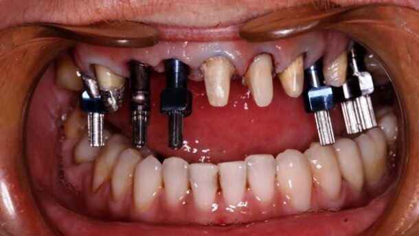 Rozwiązanie estetyczne przy wykorzystaniu pojedynczych koron na wszczepach i własnych zębach