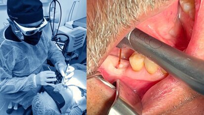 El láser en Implantología (5)