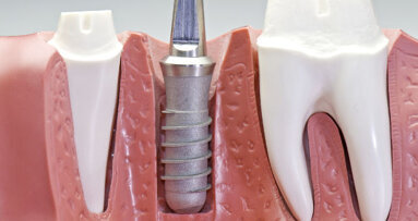 Strom soll Implantate von Bakterien befreien