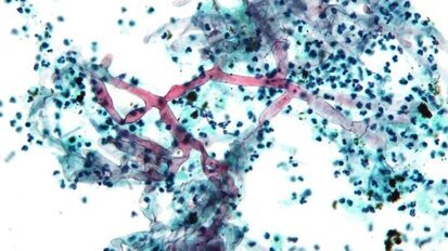 Mucor due to hyperglycemia from new strain?