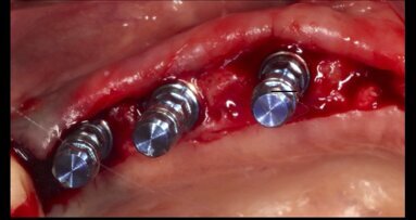 Efecto de la vitamina D en la osteointegración de los implantes dentales
