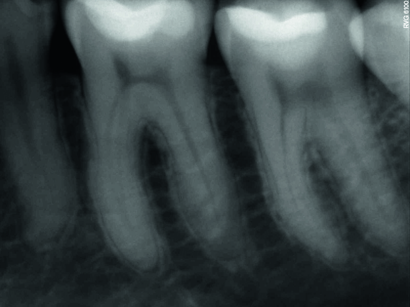 Fig. 9 : Radio à un an de suivi. 