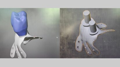 Cierre de comunicación oro-sinusal con placa de titanio personalizada 3D