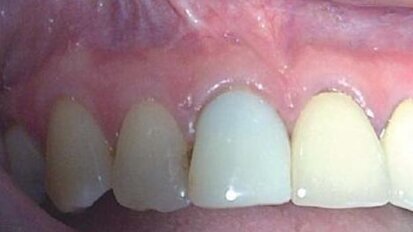 Rewizja leczenia endodontycznego po nieudanej resekcji wierzchołka korzenia