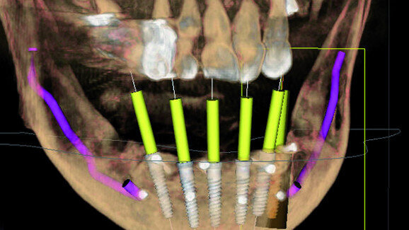 Advantages of 3-D planning for implants