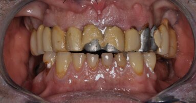 Riabilitazione del sestante mandibolare anteriore con restauri in composito ibrido stampati in 3D alla poltrona: follow-up a 7 anni