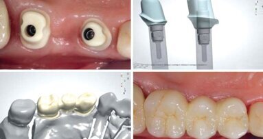 Łączniki indywidualne w odcinku bocznym