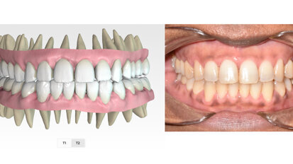 Non-invasive correction of Class III anterior open bite in 7.75 months with clear aligners