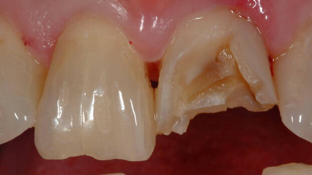 Many orofacial injuries during sports are preventable