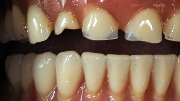 Intervención estética-funcional con barra sobre implantes en paciente con prótesis