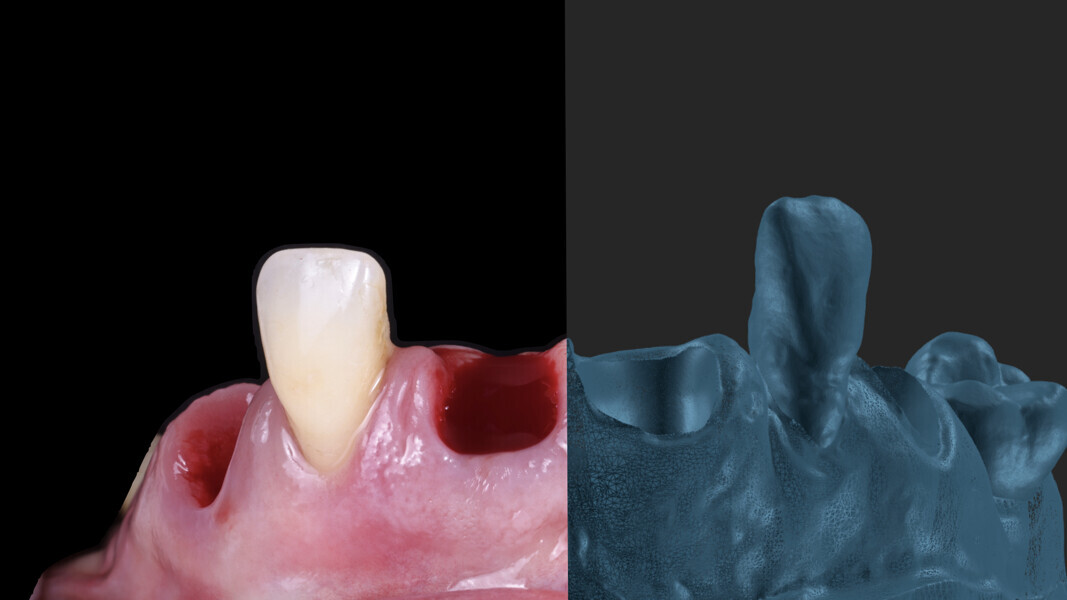 Fig. 16: Appearance of the actual papillae in the mouth vs. the appearance of the virtual papillae on the model.