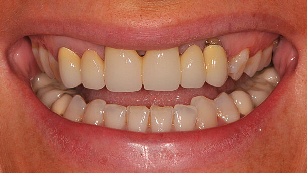 Disarmonia degli elementi frontali